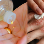 KOLONYA ZARARI OLAN MIDIR? CİLT HASTALIĞI OLANLAR DİKKAT!